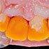 Impressão 3D na prótese dentária